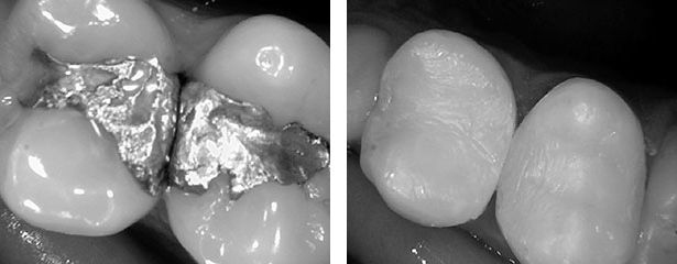 mercury filling replacement